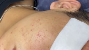 193 • Acne collection • АСМР • Relax Spa
