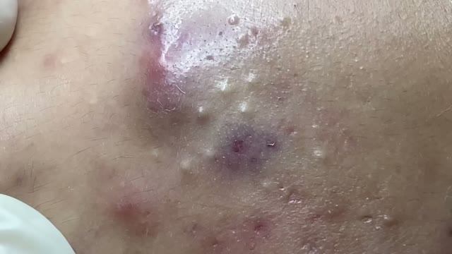 Удаление прыщей: механическая чистка лица смотреть онлайн