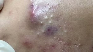 Удаление прыщей: механическая чистка лица