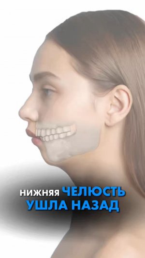 НИЖНЯЯ ЧЕЛЮСТЬ УШЛА НАЗАД