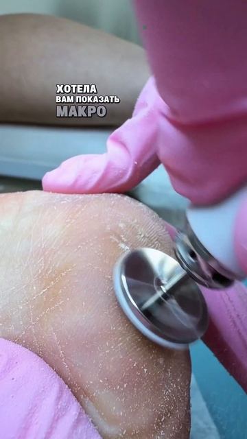 сухая пятка с трещиной 💔 педекюр перед сезоном босоножек начался ☺️