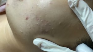 Удаление прыщей при жирной коже