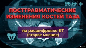 Признаки СУБХОНДРАЛЬНОГО СКЛЕРОЗА после старого ПЕРЕЛОМА КОСТЕЙ на РАСШИФРОВКЕ КТ костей таза