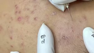 #174 Удаление прыщей. Экстрация комедонов. Подкожные прыщи. Чистка от черных точек