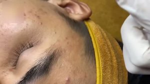 Удаление угрей и черных точек на щеках и скулах