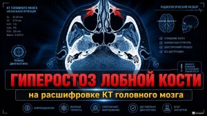 ГОЛОВНАЯ БОЛЬ после травмы при ГИПЕРОСТОЗЕ, смешанной ГИДРОЦЕФАЛИИ на РАСШИФРОВКЕ КТ головного мозга