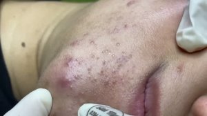 Глубокое удаление подкожных прыщей — достаем старые стержни
