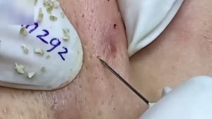 #169 Удаление прыщей. Экстрация комедонов. Подкожные прыщи. Чистка от черных точек