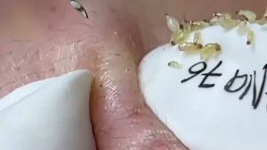 #171 Удаление прыщей. Экстрация комедонов. Подкожные прыщи. Чистка от черных точек