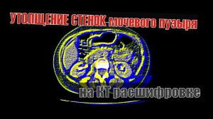 УТОЛЩЕНИЕ СТЕНОК мочевого пузыря на РАСШИФРОВКЕ КТ малого таза