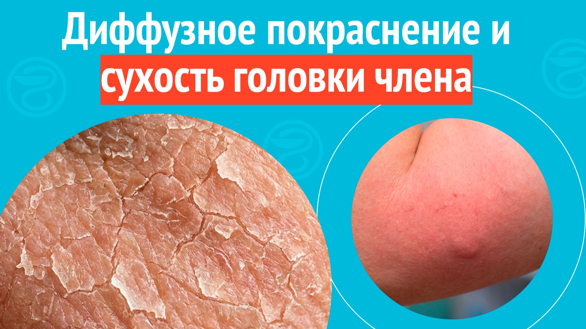 😡 Диффузное покраснение и сухость головки члена. Клинический случай № 1744 смотреть онлайн
