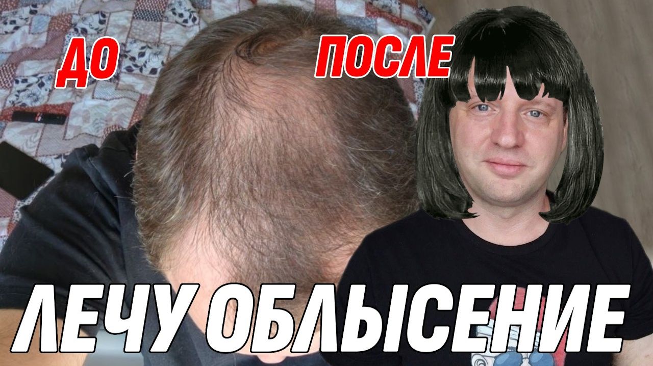 Влог: Избавиться от облысения в 45 - Без пересадок и больших вложений - Решаем задачу