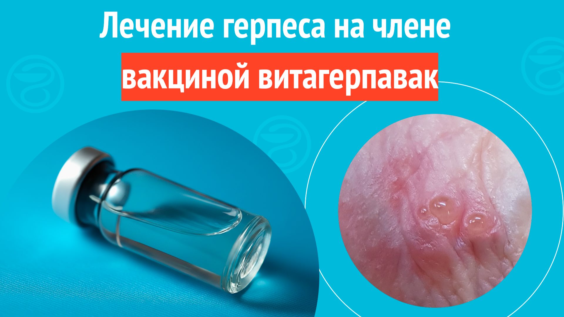 ✅ Лечение акне методом фотодинамического лазера. Клинический случай № 1802