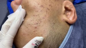 200 • Acne collection • АСМР • Relax Spa