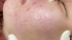 ASMR удаление белых угрей и подкожных прыщей