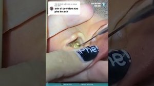 Удаление ушной серы, чистка ушей,