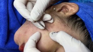 Достаем скрытые прыщи из-под кожи — жесткая чистка лица