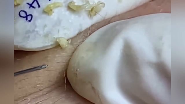 Выдавливание прыщей, угрей, черных точек и камедонов #527 смотреть онлайн
