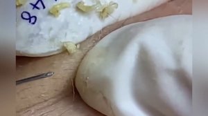 Выдавливание прыщей, угрей, черных точек и камедонов #527