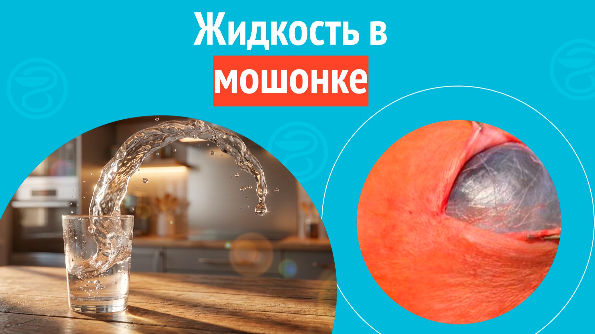 🥛 Жидкость в мошонке. Клинический случай № 1742 смотреть онлайн