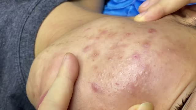 Достаем скрытые прыщи из-под кожи — жесткая чистка лица смотреть онлайн