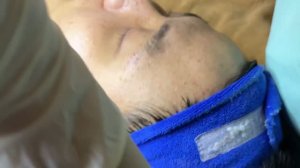 Удаление прыщей и черных точек на лице — полная экстракция
