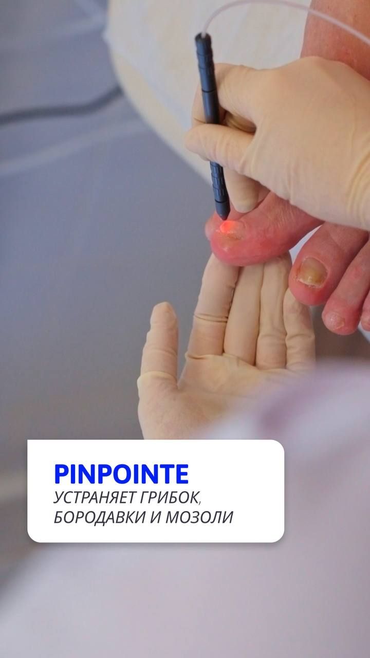 Вся правда о лечении грибка лазером PinPointe