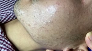 Черные точки, прыщи и то, что спрятано под кожей — удаляем всё