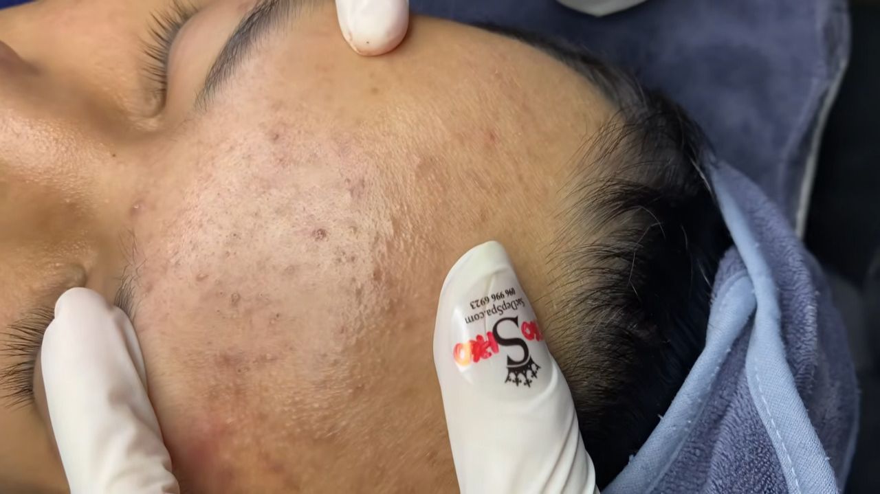 195 • Acne collection • АСМР • Relax Spa смотреть онлайн