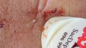 Выдавливание прыщей и угрей. Релакс видео.