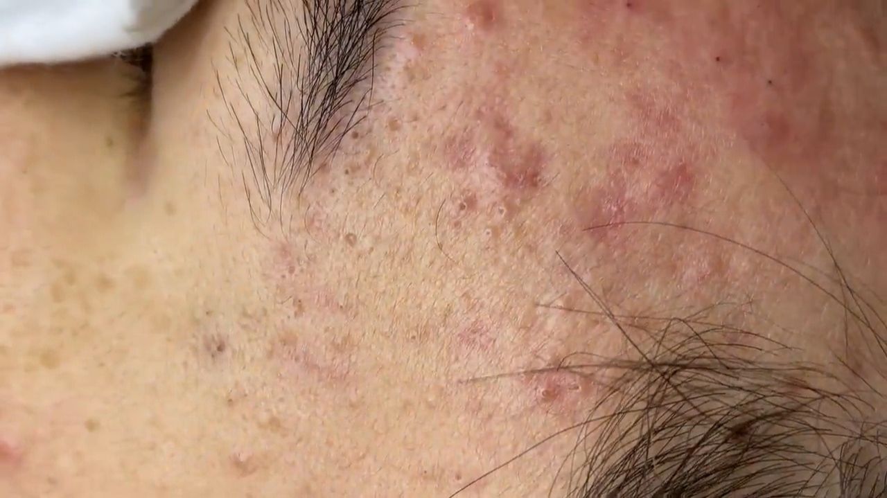 189 • Acne collection • АСМР • Relax Spa смотреть онлайн