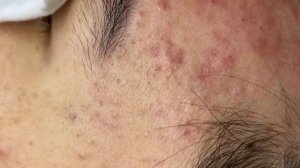 189 • Acne collection • АСМР • Relax Spa