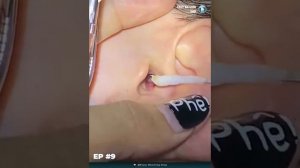 Удаление ушной серы, чистка ушей,. Прыщи