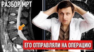 Грыжа до 30 лет, типичная ситуация. Разбор МРТ