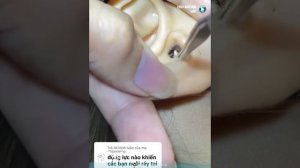 УШНАЯ СЕРА И СОЧНЫЕ ПРЫЩИ