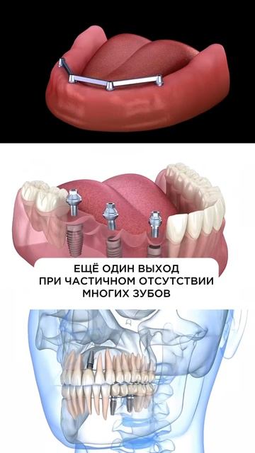 Потеря нескольких зубов? Есть выход!