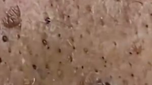 Это видео забанят! Жесть: удаление огромных угрей.