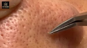 ВЫДАВЛИВАЕТ ПРЫЩИ И УГРИ. СОЧНОЕ РЕЛАКС ВИДЕО