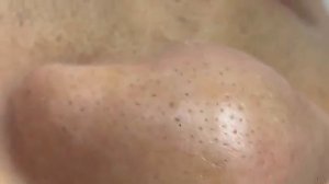 กดสิว blackheads filaments on nose remove with tweezers (1)