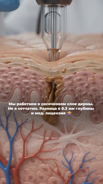 Сосочковый слой - это верхняя треть дермы.