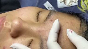 Удаление множественных комедонов — чистка лица