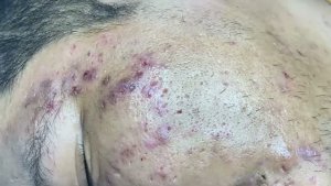 Удаление черных точек и комедонов в спа