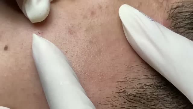 Удаление воспаленных прыщей и комедонов смотреть онлайн