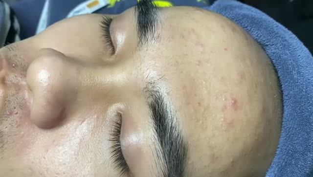 Удаление скрытых прыщей, черных точек и подкожных кист смотреть онлайн