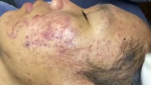 Удаление множественных комедонов на лбу и щеках