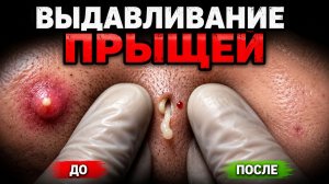 ЧЕРНЫЕ ТОЧКИ, ПРЫЩИ И ГЛУБОКАЯ ЧИСТКА КОЖИ | ДОЛГОЕ ВИДЕО