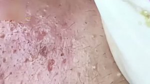 #203 Удаление акне. Экстрация комедонов. Подкожные прыщи. Чистка от черных точек