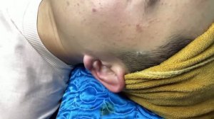 Удаление черных точек — полная чистка щек