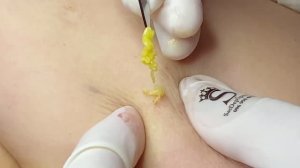 Липомы и множественные кисты сальных желез на руке