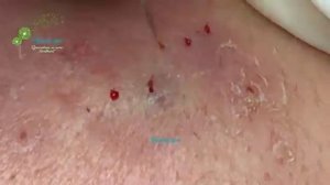 ВЫДАВЛИВАЕТ ПРЫЩИ И УГРИ. СОЧНОЕ РЕЛАКС ВИДЕО